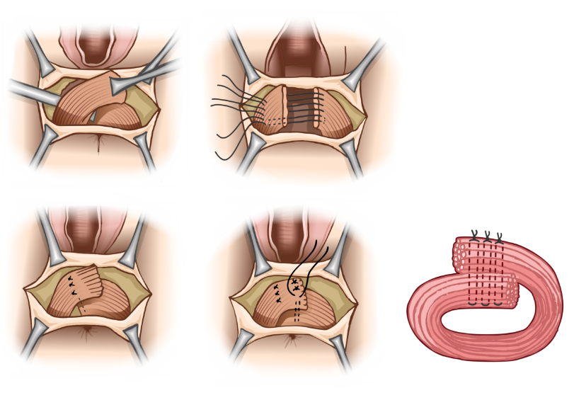 Reparo por sobreposição do esfíncter anal