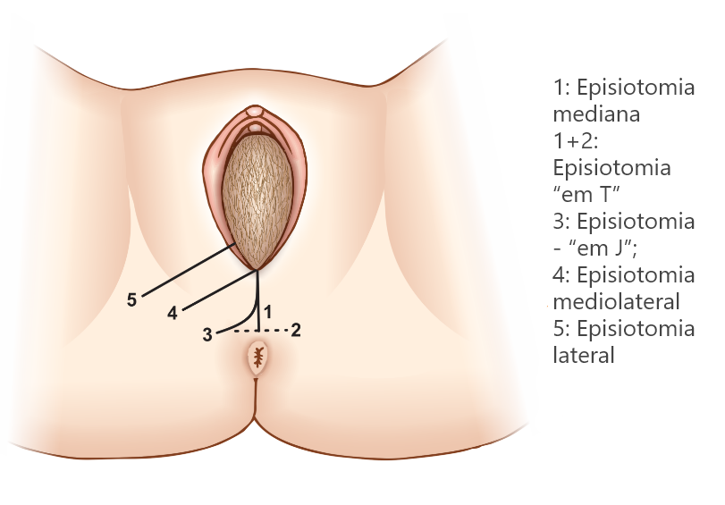 Tipos de episiotomia