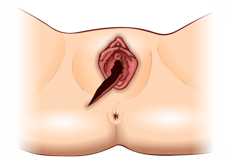 Incisão mediolateral