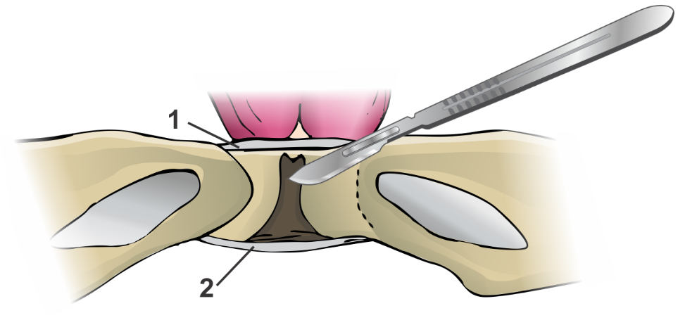 Sinfisiotomia