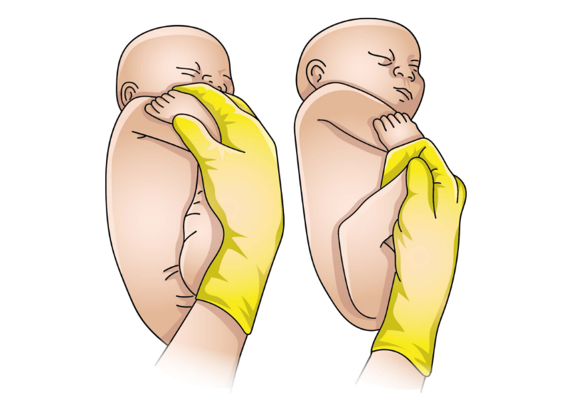 Apreensão e tração inferior do pé fetal anterior (alternativa Manobra de Pinard)