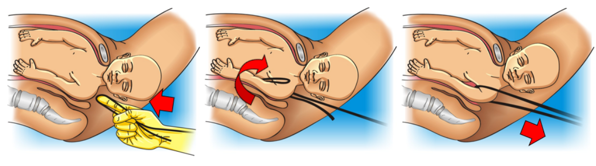 Extração do ombro posterior