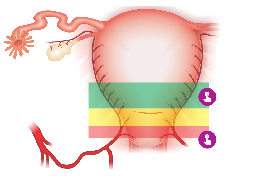 Histerotomia