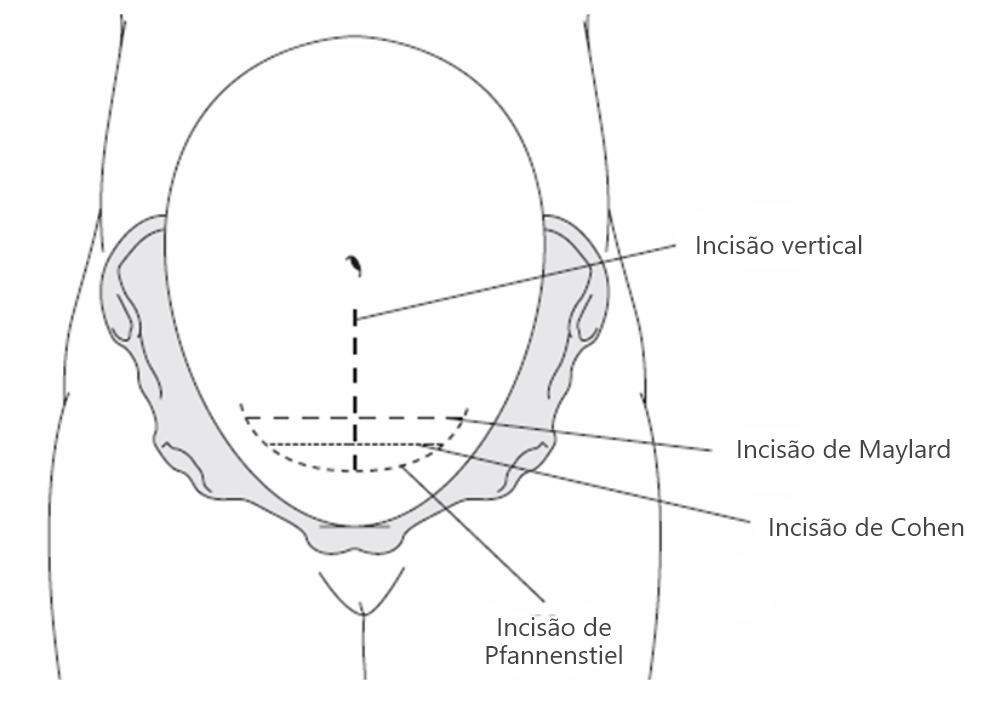 Tipos de incisões na pele