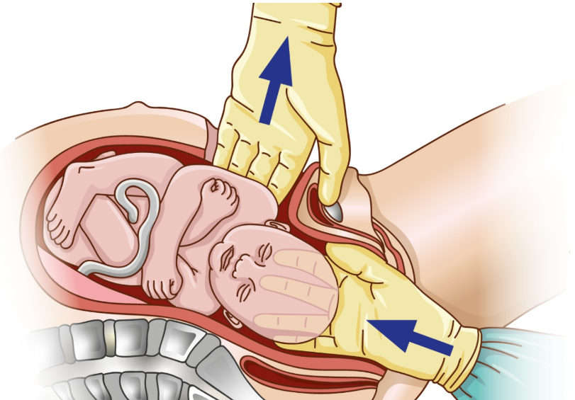 Extração abdominovaginal (push method)