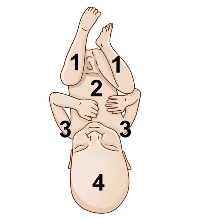 Manobra de Patwardhan – primeira proposta com dorso posterior