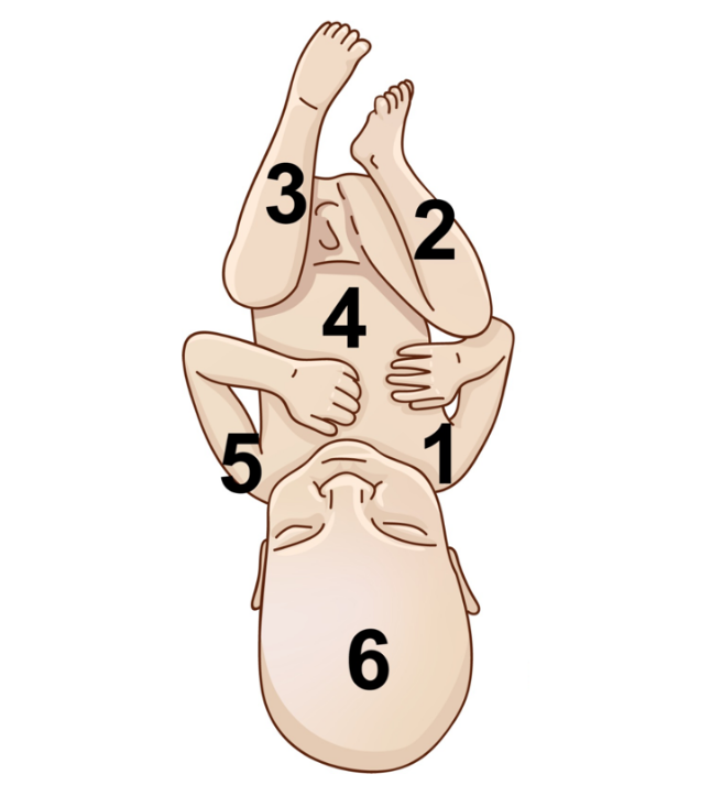 Manobra de Patwardhan – segunda proposta com dorso posterior